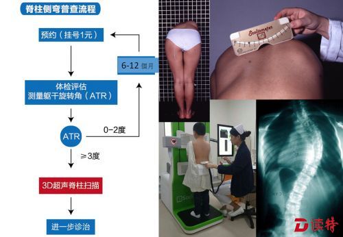香港大学深圳医院骨科利用内地唯一的3D超声系统开展无辐射的脊柱...
