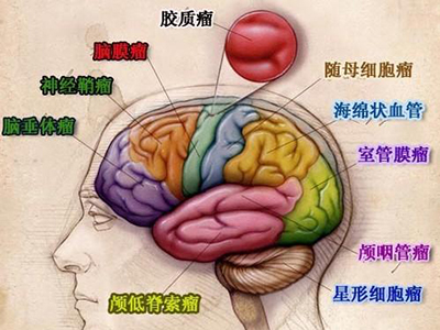 脑胶质瘤偏爱中年大叔！难道跟这样东西有关？