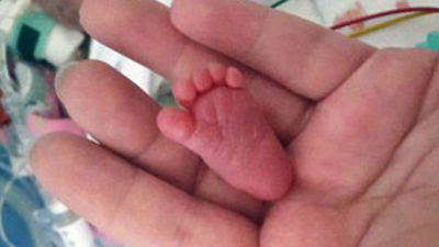 真的是拇指姑娘！世界最轻婴儿体重仅4两 