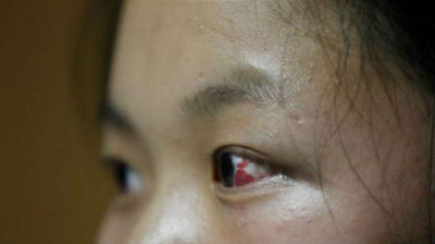 深圳15岁女生被女同学群殴 眼睛充血浑身是伤