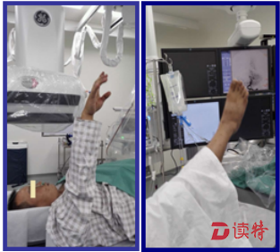 小阳术后在手术床上右侧肢体肌力即刻完全恢复