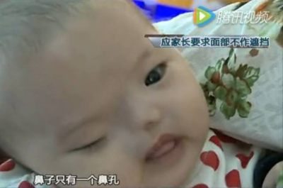 刚出生女婴没鼻子没眼睛 8次产检均显示正常