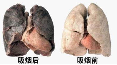肺癌发病率上升 专家建议早点检查