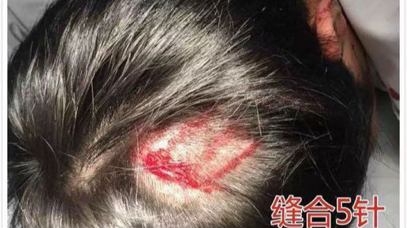 酗酒者太嚣张！120医护人员接诊患者竟被殴
