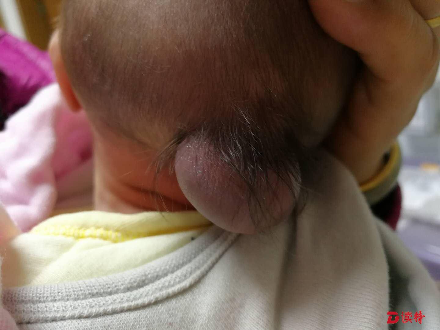 婴儿头上竟长出“尾巴” 只因孕妈少吃了这个......