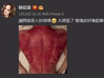 头皮发麻！阿娇晒出的这张照片，医生都看不下去了