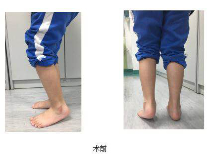 全省首例！这个手术让瘫痪孩子实现“不可能”的站立