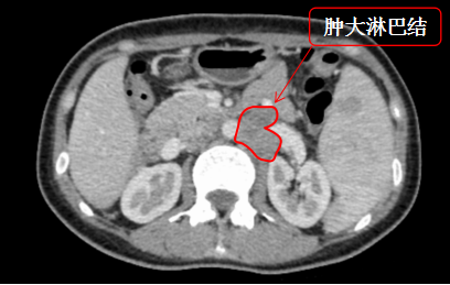 肚脐眼上冒出个“美人痣”？No！这是癌症，吓skr！ 