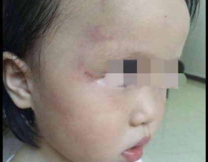 广州增城某幼儿园虐童事件最新进展:涉事幼儿园教师被刑拘