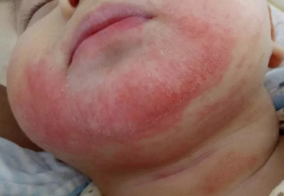 深圳8个月大的宝宝太可爱，脸蛋被长辈捏“烂”了 ，怎么回事？