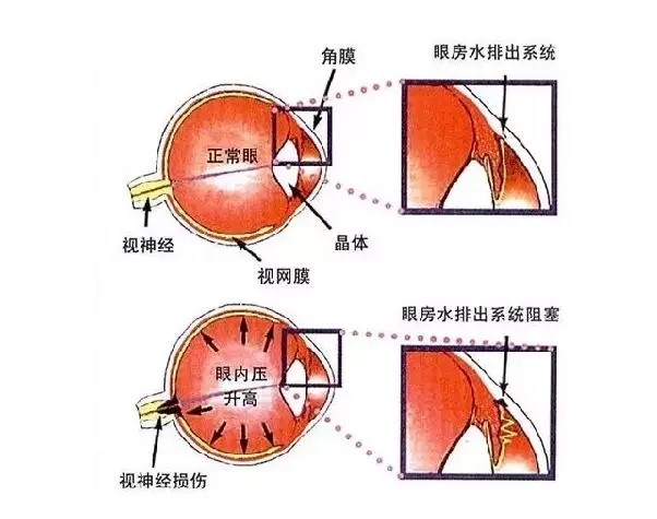 睡前关灯玩手机别作了当心青光眼永远夺去你的视力