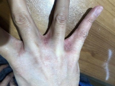 （重稿勿改）深圳一市民因洗手过度洗出湿疹