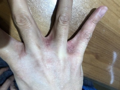 勤洗手导致双手又红又痒引起湿疹！专家提醒市民洗手后要及时涂抹润手霜   