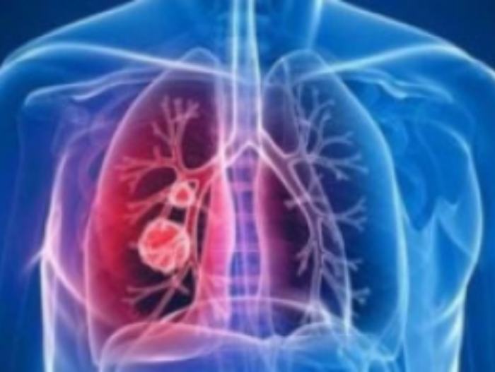 加拿大新冠肺炎确诊病例突破1000 死亡12例