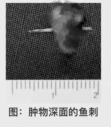 女子舌头肿胀险致癌！“罪魁祸首”竟是餐桌上常见的它