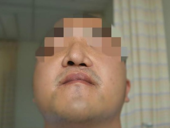 江西小伙饱受鼻唇畸形20载，在深圳获得“微笑脸”