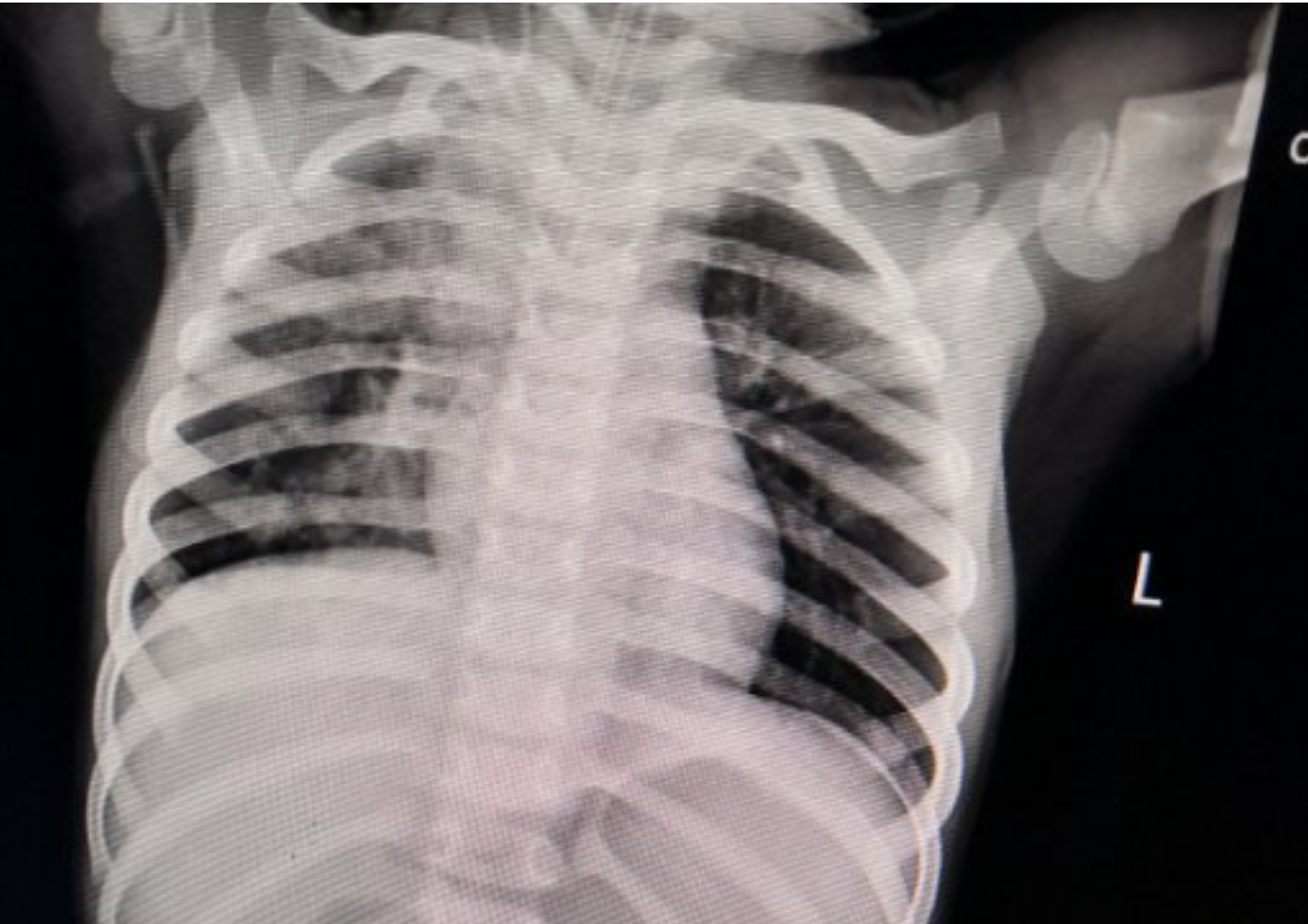 家长们一定要注意！两岁幼儿误吞磁珠被送进ICU