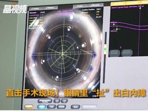 ​直击手术现场！眼睛里“扯”出白内障