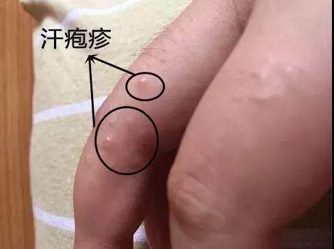 健康365 | 一到夏天双手就“冒泡”还脱皮？汗疱疹了解一下