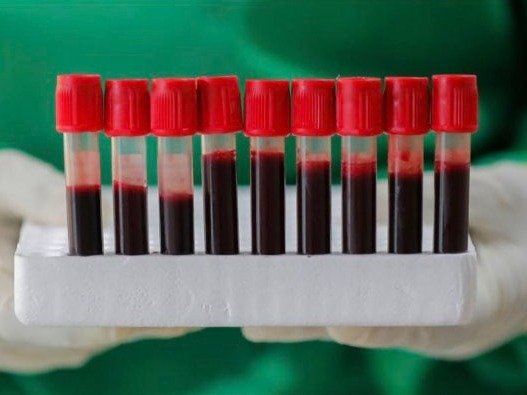 最新研究：新冠病毒感染风险与血型相关性不强