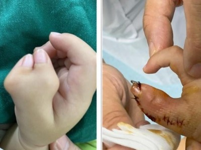一岁男娃拇指似“蟹钳”，医生用绣花功夫妙手矫正