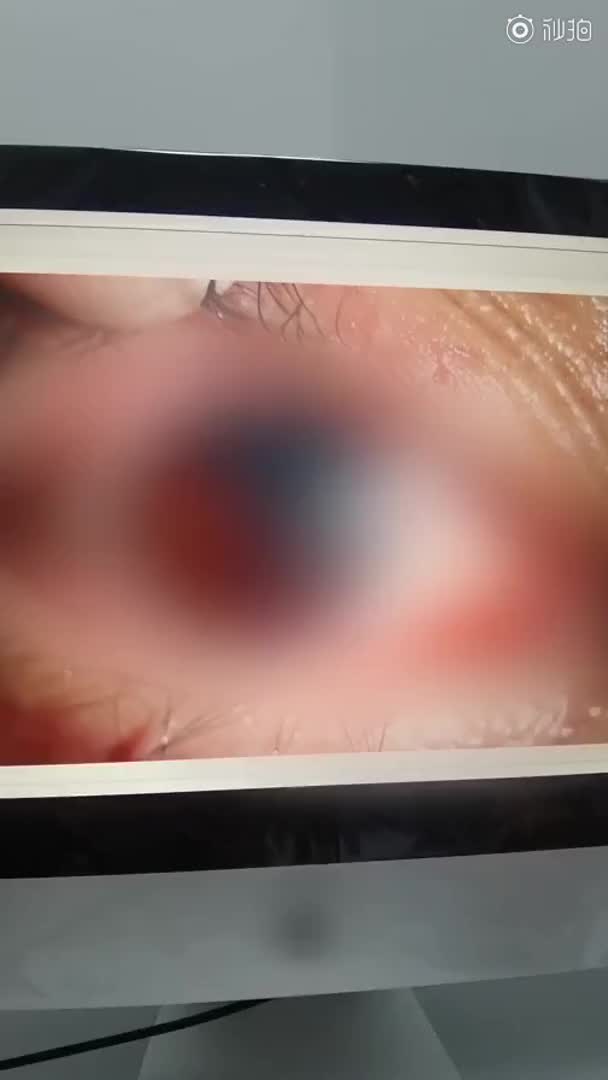 提醒！女孩保温杯泡红枣10多天拧开爆炸：致眼球破裂