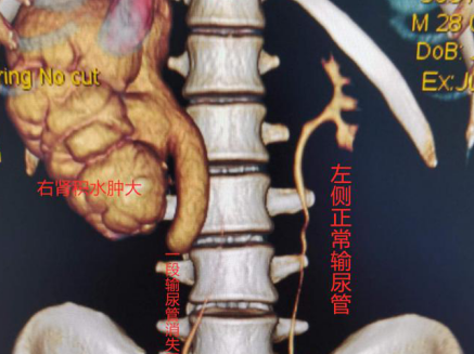 体检发现输尿管“丢失”半截？南科大医院为畸形输尿管“微创整形复位”