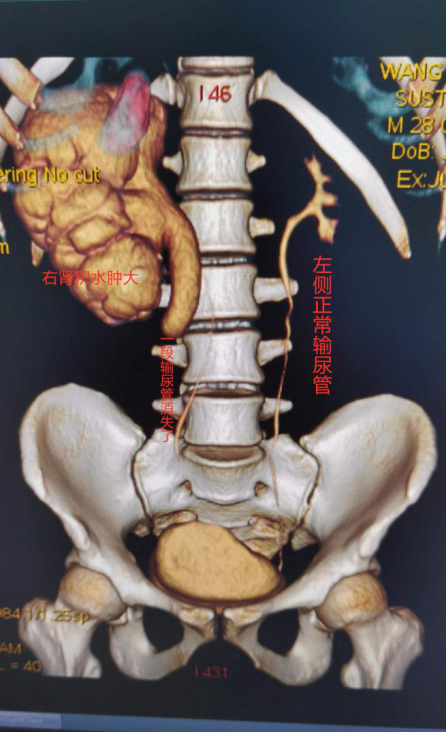 体检发现输尿管丢失半截南科大医院为畸形输尿管微创整形复位