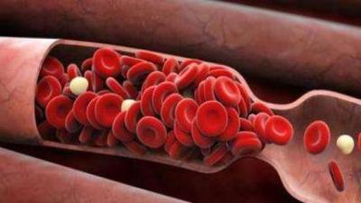 新型人造血管治疗急性血栓更有效，将在动物活组织上测试