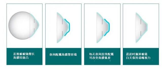 OK镜到底O不OK？中山七院眼科专家这么说