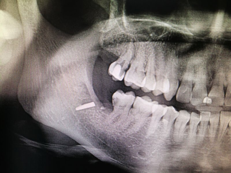 女子拔牙多天后仍发炎脓肿 检查发现拔牙工具断裂其中