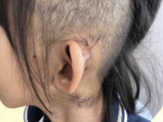 6岁女孩能更清晰地听见声音啦！中山七院顺利完成首例人工耳蜗植入手术