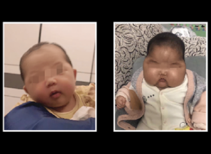 如何避开激素宝宝霜的坑？深圳市消委会联合市慢性病防治中心答疑解惑