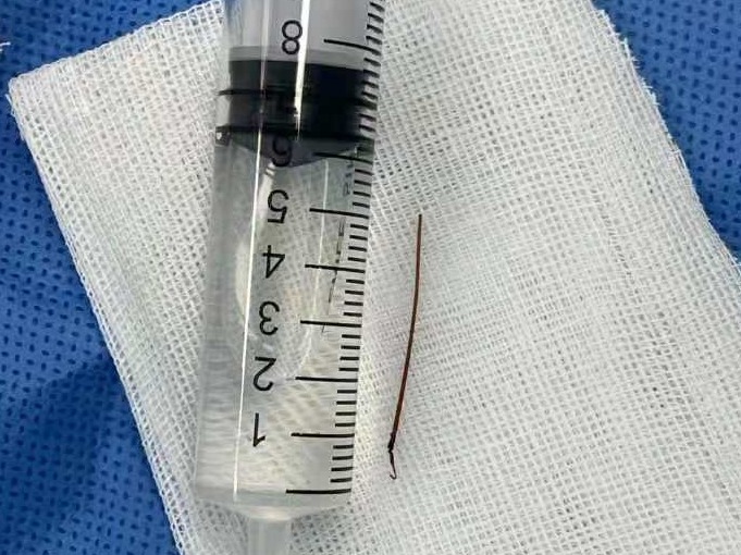 6岁娃过年被竹席扎进臀部 引来惊险一幕……