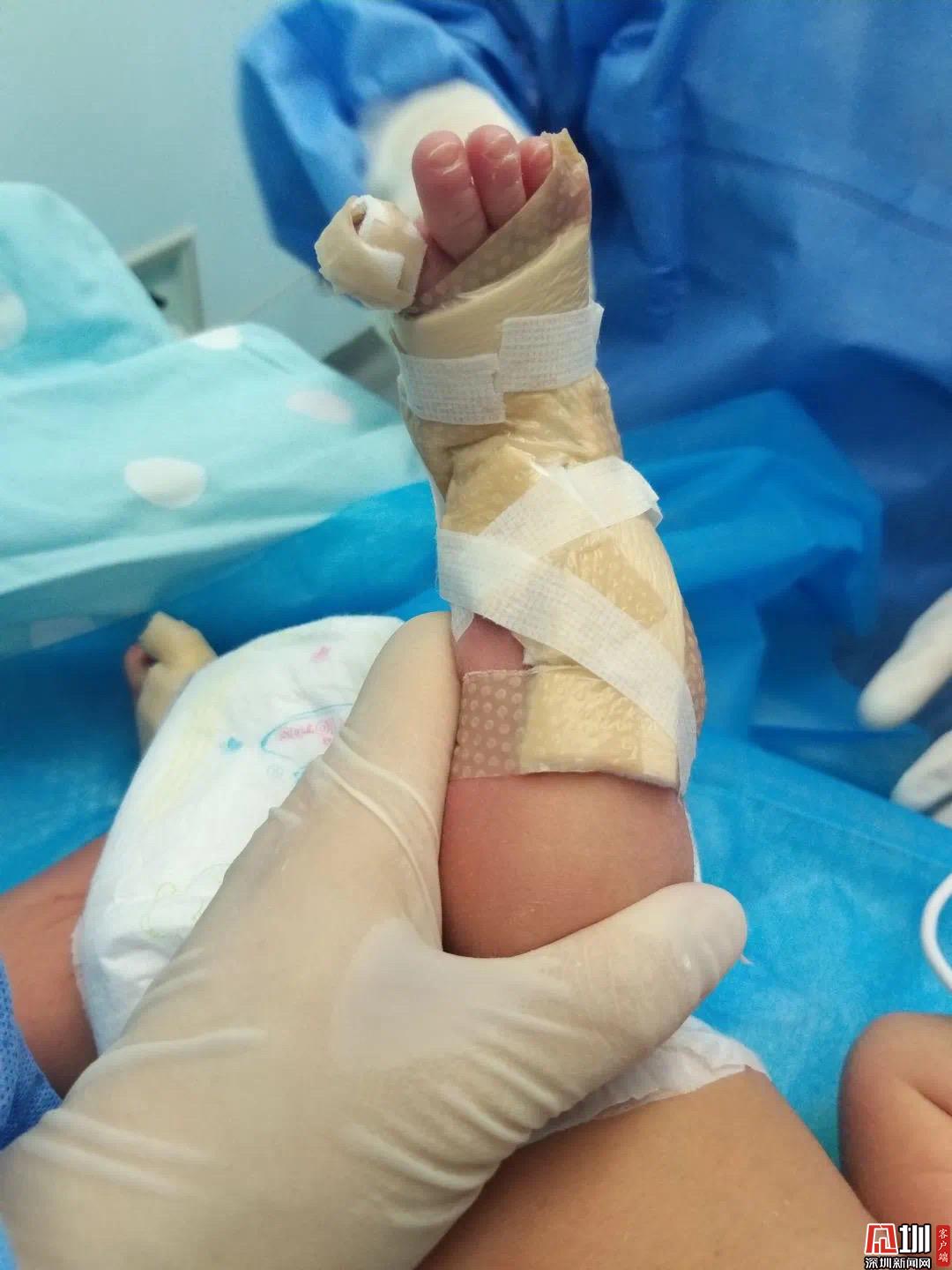 出生时小腿仿佛被剥皮 发病率仅为十万分之一 深圳市三院救治一名先天性皮肤缺损患儿