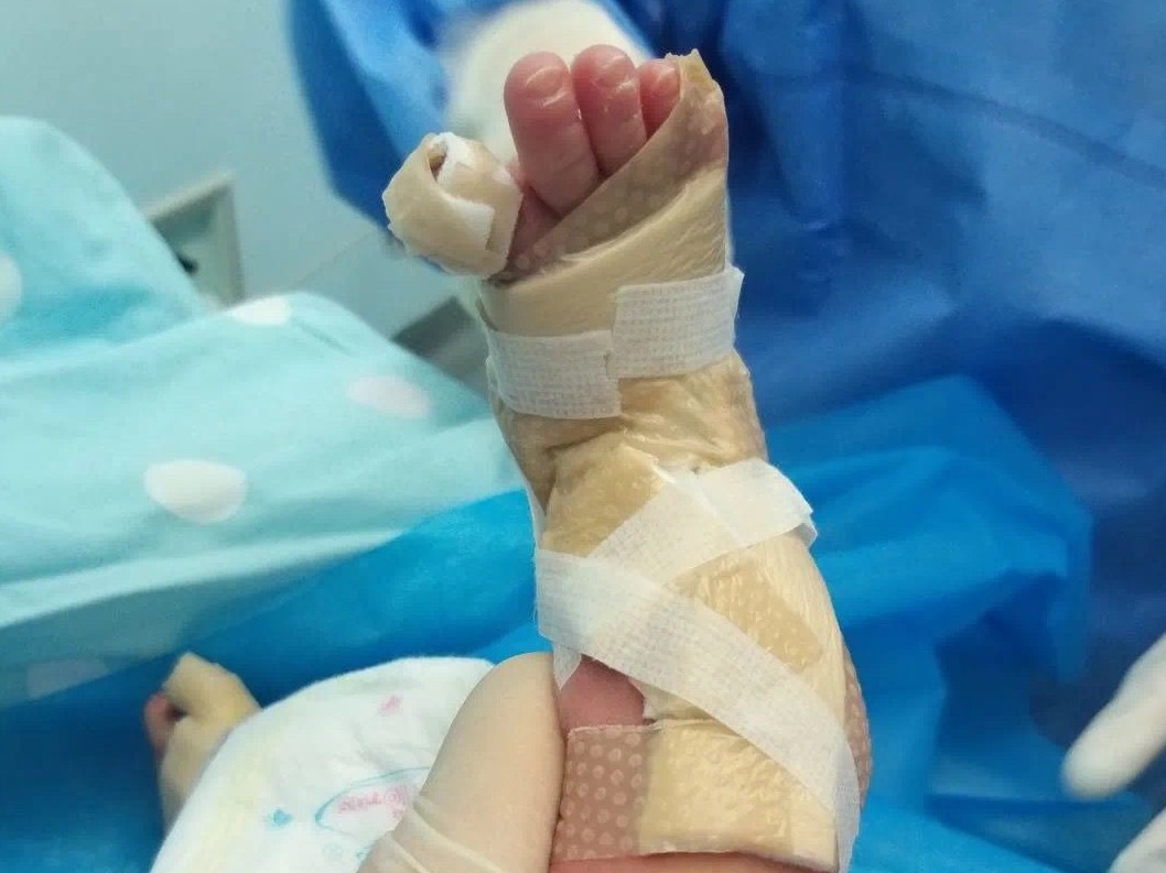 出生时小腿仿佛被剥皮！深圳市三院救治一名先天性皮肤缺损患儿