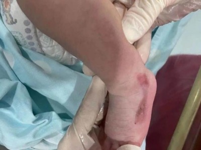 出生时小腿仿佛被剥皮 发病率仅为十万分之一 深圳市三院救治一名先天性皮肤缺损患儿