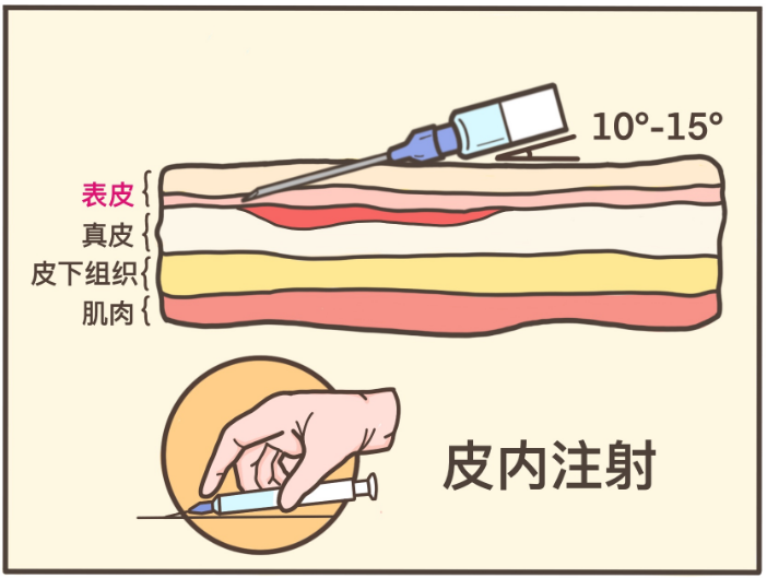 76皮内注射,最疼不同的打法,要求的进针角度不同,触达的组织也不同