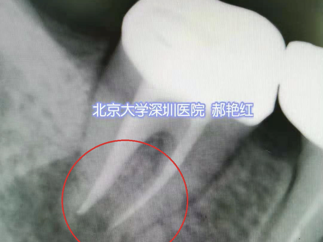 拔下来的坏牙再种回去  “活了”！北大深圳医院医生巧手留住天然牙