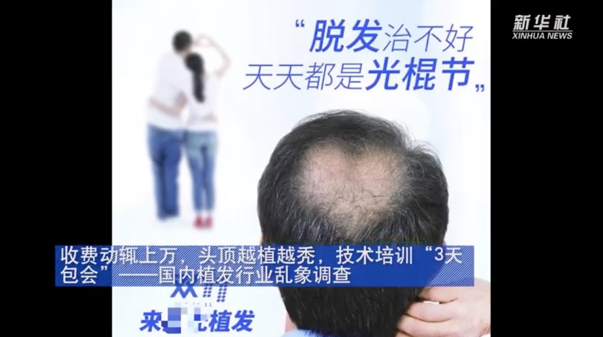 给你植发的人靠谱吗，植发技术三天速成