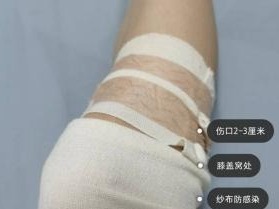 “小腿肌肉阻断术”冲上热搜，医生：无异于自残，且不可修复