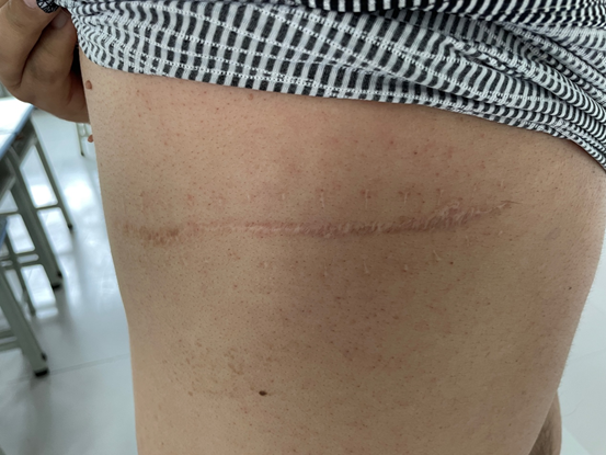 图：努尔麦麦提中弹后留下的伤痕