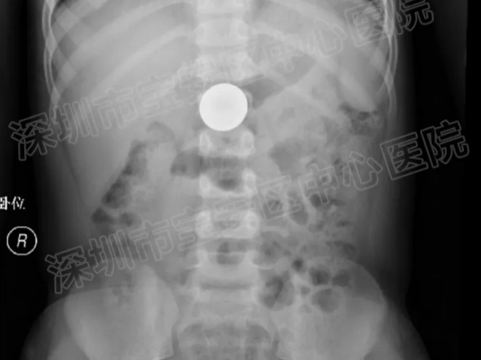六岁男童好奇吞硬币，卡在胃里一星期出不来