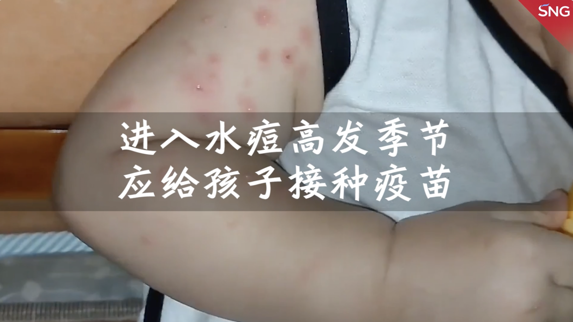 水痘高发季来临，深圳疾控专家建议接种疫苗预防