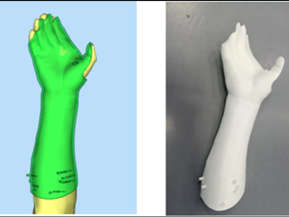 中风后痉挛性瘫痪怎么办？“3D打印+肉毒素”来解难