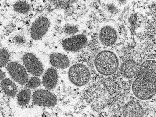 日媒：猴痘病毒存在人传人可能，暂无治疗方法