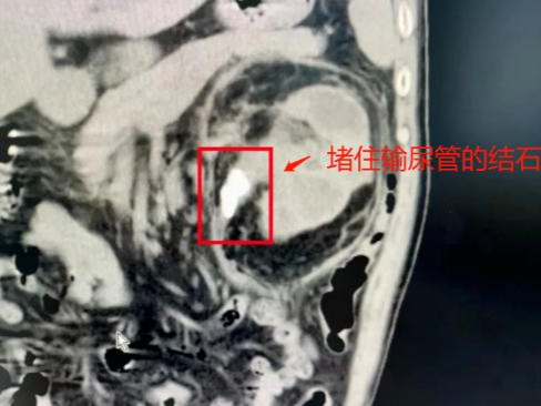 男子腰痛按“腰肌劳损”治了一个月才知道是肾爆了！