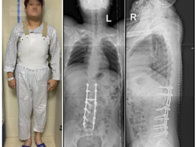 20岁大学生脊柱侧弯6年，骨科团队+AI助力让他挺直脊梁