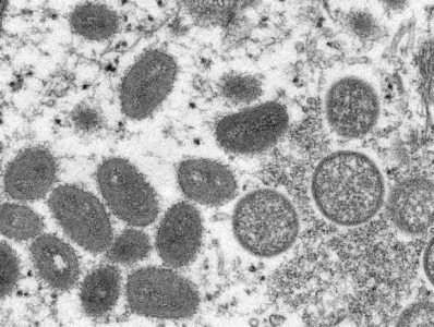 世卫宣布7月21日召开第二次猴痘紧急会议，全球病例已近万