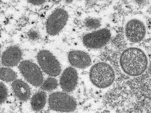 世卫宣布猴痘疫情为“国际关注的突发公共卫生事件”